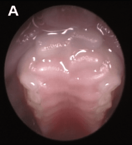 Pathologies dentaires et malocclusions chez l'octodon 2 Vue intrabuccale montrant les premières prémolaires et molaires d’un jeune octodon.